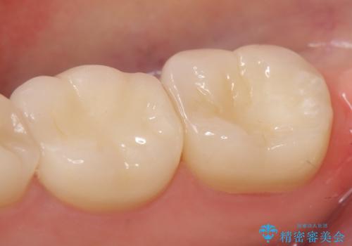 オールセラミッククラウン 違和感のある奥歯の治療の治療後