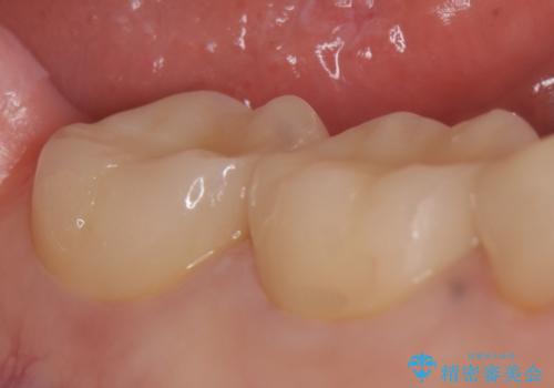 オールセラミッククラウン 違和感のある奥歯の治療の治療後