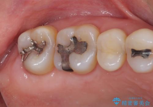 銀歯の中が虫歯になった ゴールドインレーによる修復治療の治療前