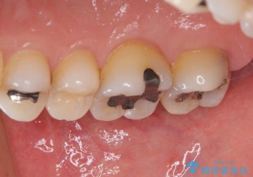 銀歯の中が虫歯になった ゴールドインレーによる修復治療の治療前