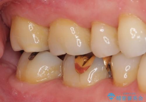 銀歯の中が虫歯になった ゴールドインレーによる修復治療の治療前