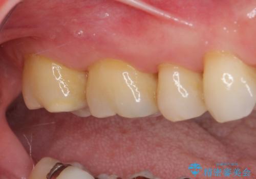 銀歯の中が虫歯になった ゴールドインレーによる修復治療の治療前