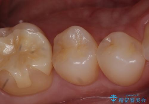 セラミックインレー しみる歯の治療の治療前