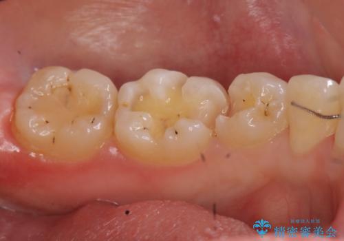 歯と歯の間の虫歯治療　セラミックインレーで治療の治療中