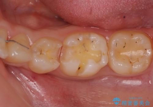 歯と歯の間の虫歯治療 セラミックインレーで治療の治療中