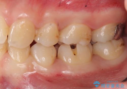歯と歯の間の虫歯治療 セラミックインレーで治療の治療中