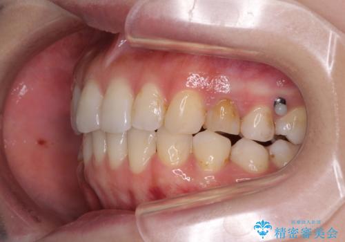 総合歯科治療　矯正治療と失活歯のセラミック補綴治療の治療中