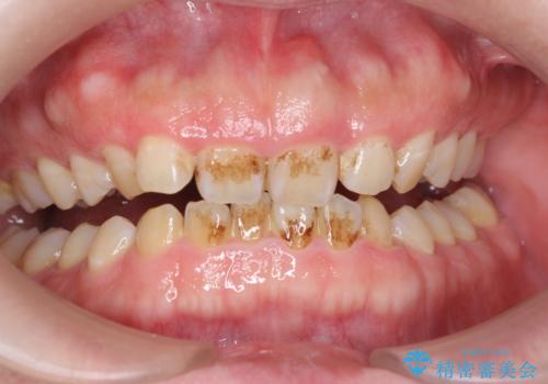 歯の着色をPMTCで、きれいにして口元爽やかに!の症例 治療前