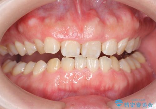 歯の着色をPMTCで、きれいにして口元爽やかに!の症例 治療後