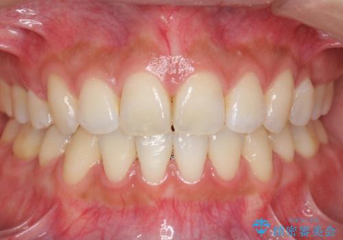 えっ シワが矯正で消えちゃう・・・? ボトックスから卒業しようの治療後