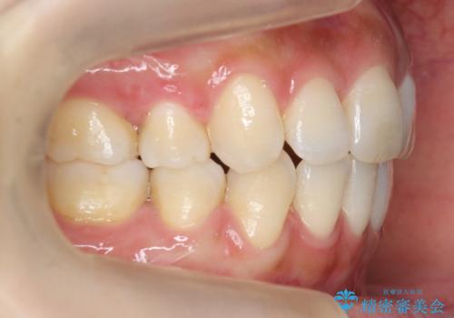 えっ シワが矯正で消えちゃう・・・? ボトックスから卒業しようの治療後