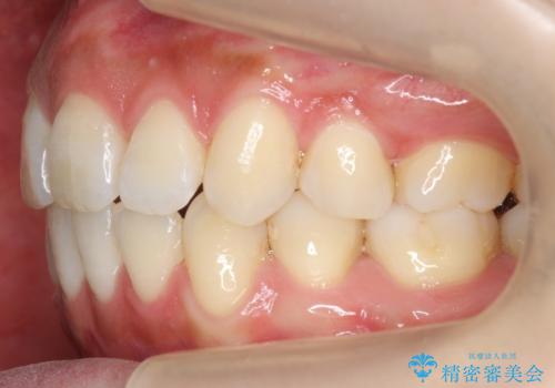 えっ シワが矯正で消えちゃう・・・? ボトックスから卒業しようの治療後