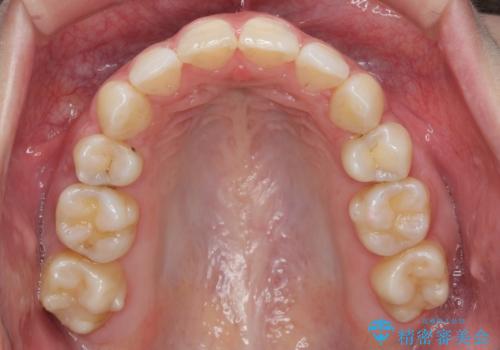 えっ シワが矯正で消えちゃう・・・? ボトックスから卒業しようの治療後