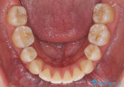 えっ シワが矯正で消えちゃう・・・? ボトックスから卒業しようの治療後