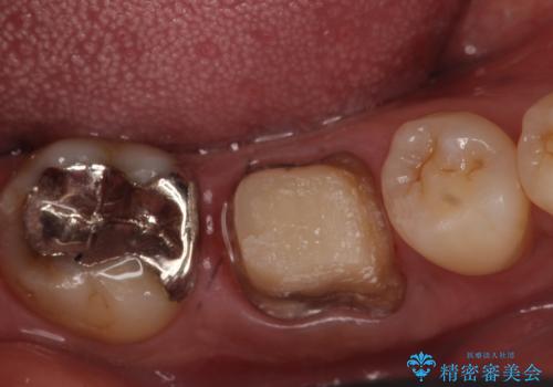 オールセラミッククラウン 歯茎から膿が出る歯の治療の治療中