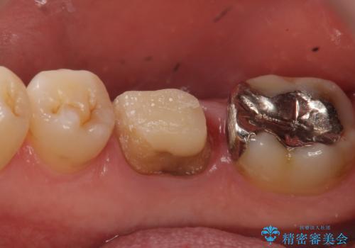 オールセラミッククラウン　歯茎から膿が出る歯の治療の治療中