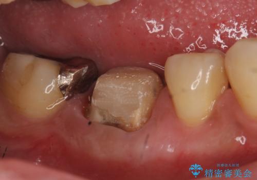 オールセラミッククラウン　歯茎から膿が出る歯の治療の治療中