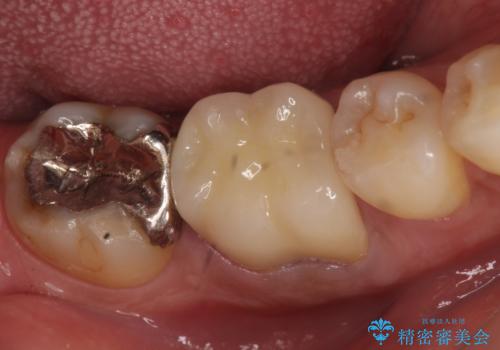 オールセラミッククラウン　歯茎から膿が出る歯の治療の治療後
