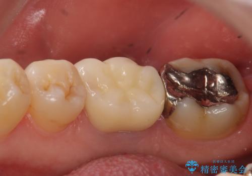 オールセラミッククラウン 歯茎から膿が出る歯の治療の治療後