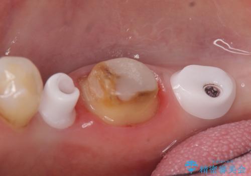 インプラント　咬めない奥歯の治療の治療中
