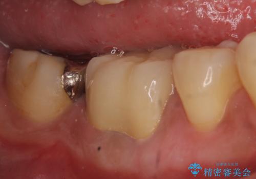 オールセラミッククラウン　歯茎から膿が出る歯の治療の治療後