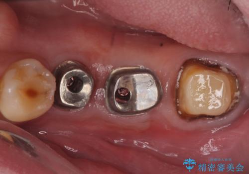 インプラント　失った奥歯の欠損補綴の治療中