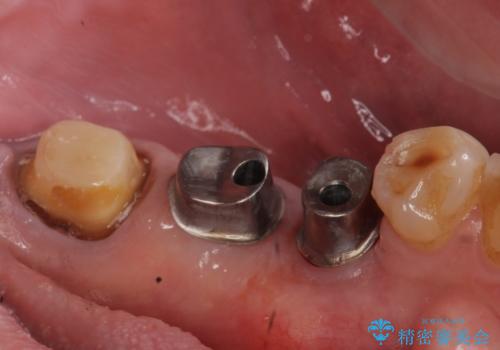 インプラント 失った奥歯の欠損補綴の治療中