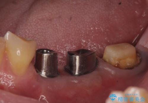 インプラント 失った奥歯の欠損補綴の治療中