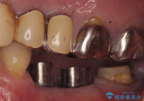 インプラント　失った奥歯の欠損補綴の治療中