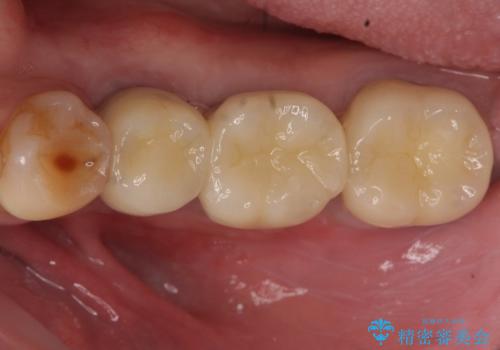 インプラント 失った奥歯の欠損補綴の治療後