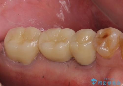 インプラント 失った奥歯の欠損補綴の治療後