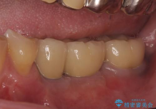 インプラント 失った奥歯の欠損補綴の治療後