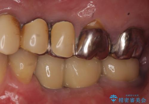インプラント 失った奥歯の欠損補綴の治療後