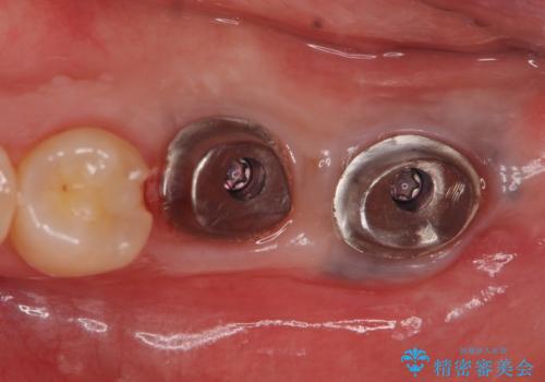 インプラント 失ってしまった奥歯の再建の治療中
