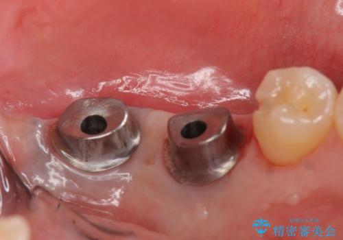 インプラント 失ってしまった奥歯の再建の治療中