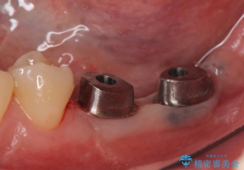 インプラント 失ってしまった奥歯の再建の治療中
