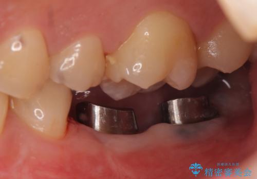 インプラント 失ってしまった奥歯の再建の治療中