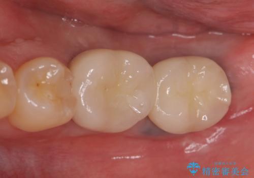 インプラント 失ってしまった奥歯の再建の症例 治療後