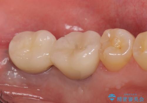 インプラント 失ってしまった奥歯の再建の治療後