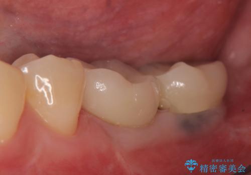 インプラント 失ってしまった奥歯の再建の治療後