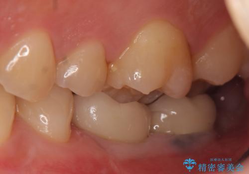 インプラント 失ってしまった奥歯の再建の治療後
