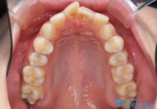 えっ シワが矯正で消えちゃう・・・? ボトックスから卒業しようの治療前