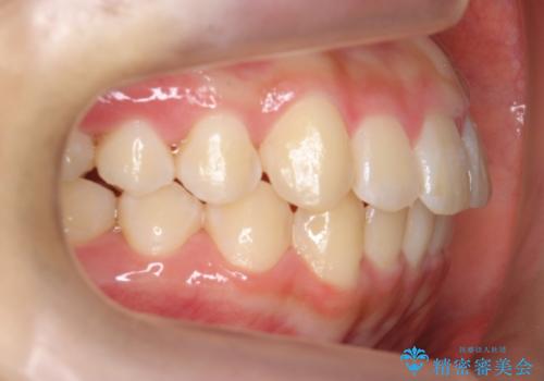 中学生のマウスピース矯正 歯を抜かずにキレイにの治療後