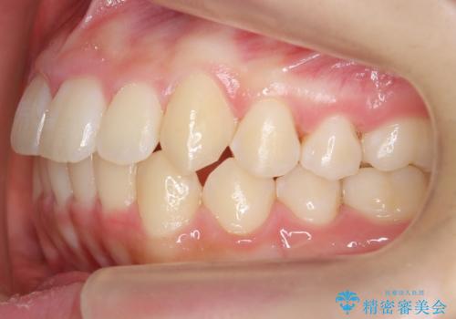 中学生のマウスピース矯正 歯を抜かずにキレイにの治療後