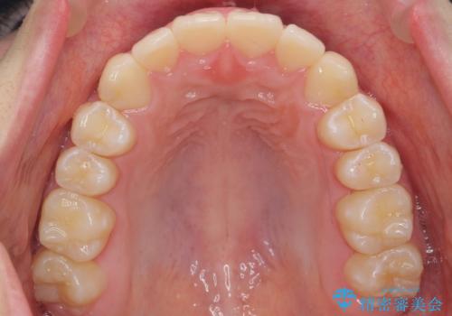 中学生のマウスピース矯正 歯を抜かずにキレイにの治療後