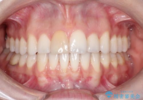 インビザラインによる非抜歯での八重歯の矯正　の症例 治療後