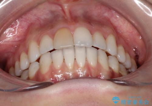 インビザラインによる非抜歯での八重歯の矯正 の治療後