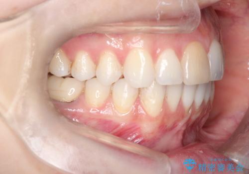 インビザラインによる非抜歯での八重歯の矯正 の治療後