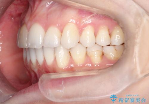 インビザラインによる非抜歯での八重歯の矯正　の治療後