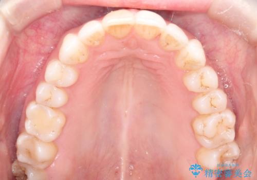 インビザラインによる非抜歯での八重歯の矯正 の治療後